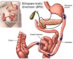 Biliopancreatic Diversion