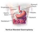 Gastroplasty