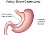 Sleeve_gastrectomy