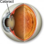 cataract_eye