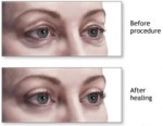 cosmetic-eye-surgery