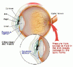 glaucoma-diagram