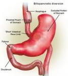 Best Laparoscopic Gastric Bypass (Rygbp) in India